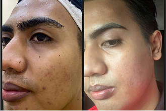 acne prone skin-1