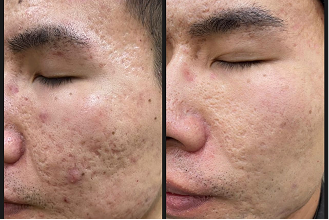acne prone skin